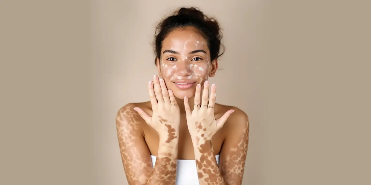 How Vitiligo Cure In Ayurveda Works