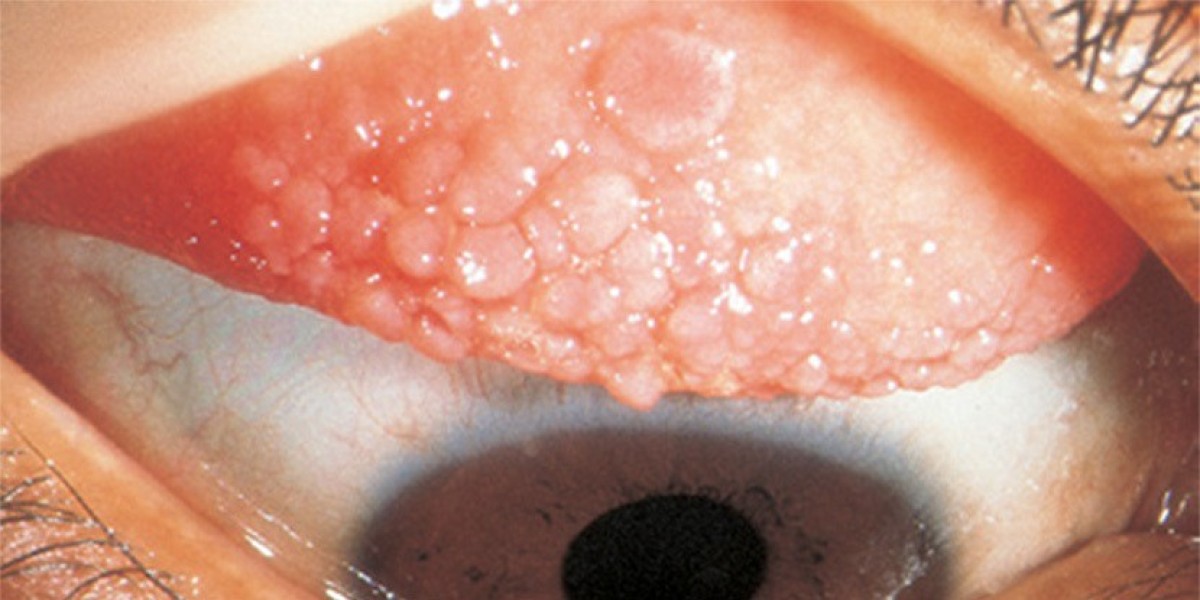 Giant Papillary Conjunctivitis Market Size, Share, Growth And Analysis 2021 Forecast to 2030.