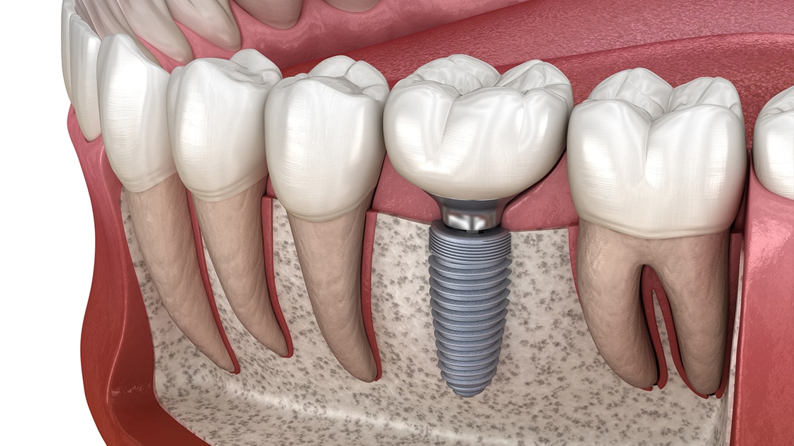 Dental Implants Can Prevent Tooth Decay: Learn How | Kelly Dentistry