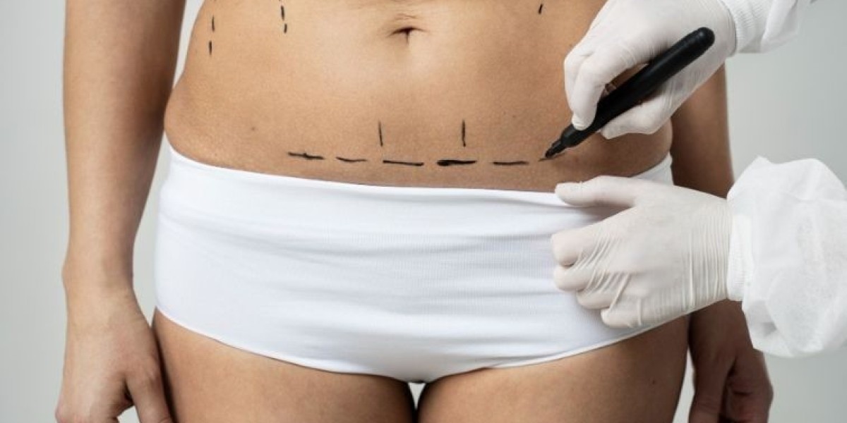 Hidden Costs of Tummy Tuck Surgery: A Price Breakdown