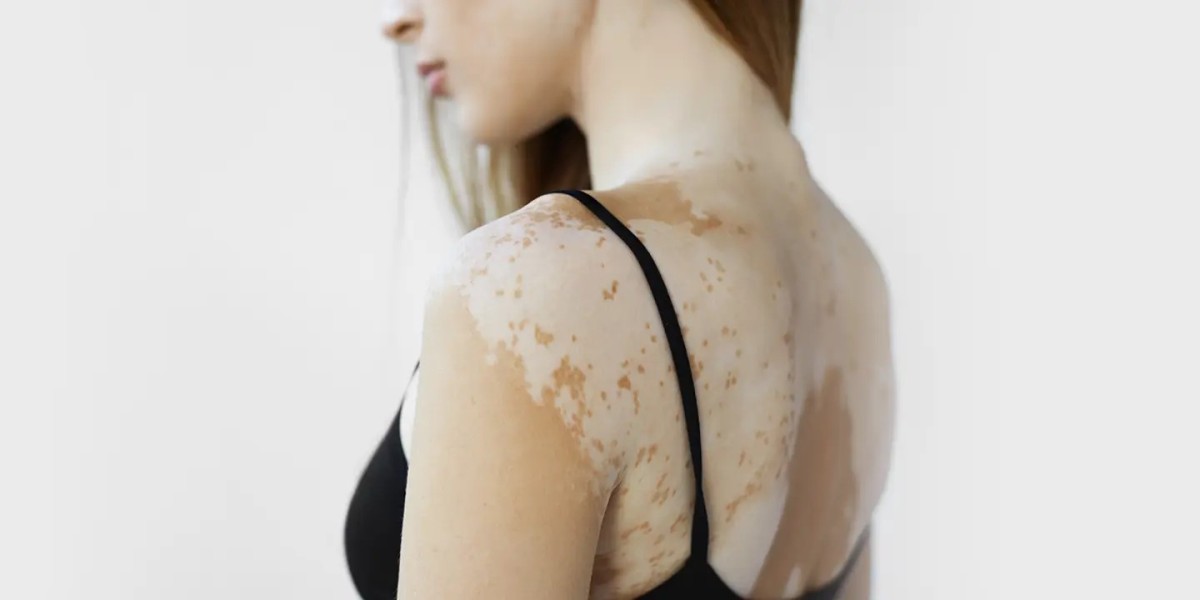 Can Vitiligo Spread From One Person To Another