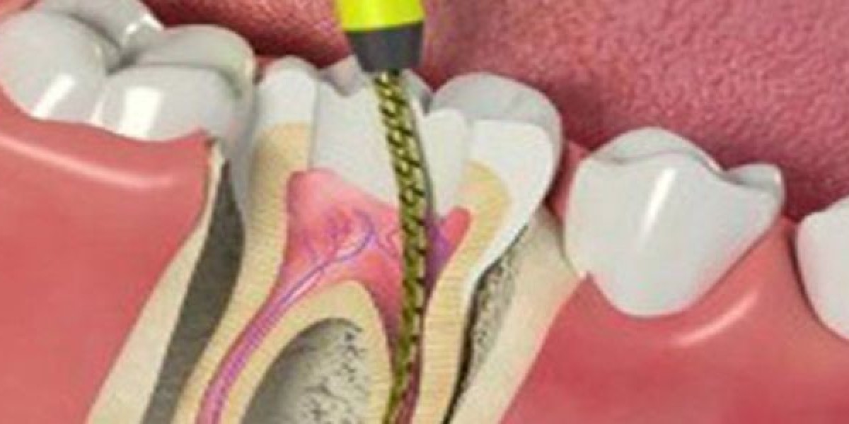 How Do You Fix A Cracked Tooth?