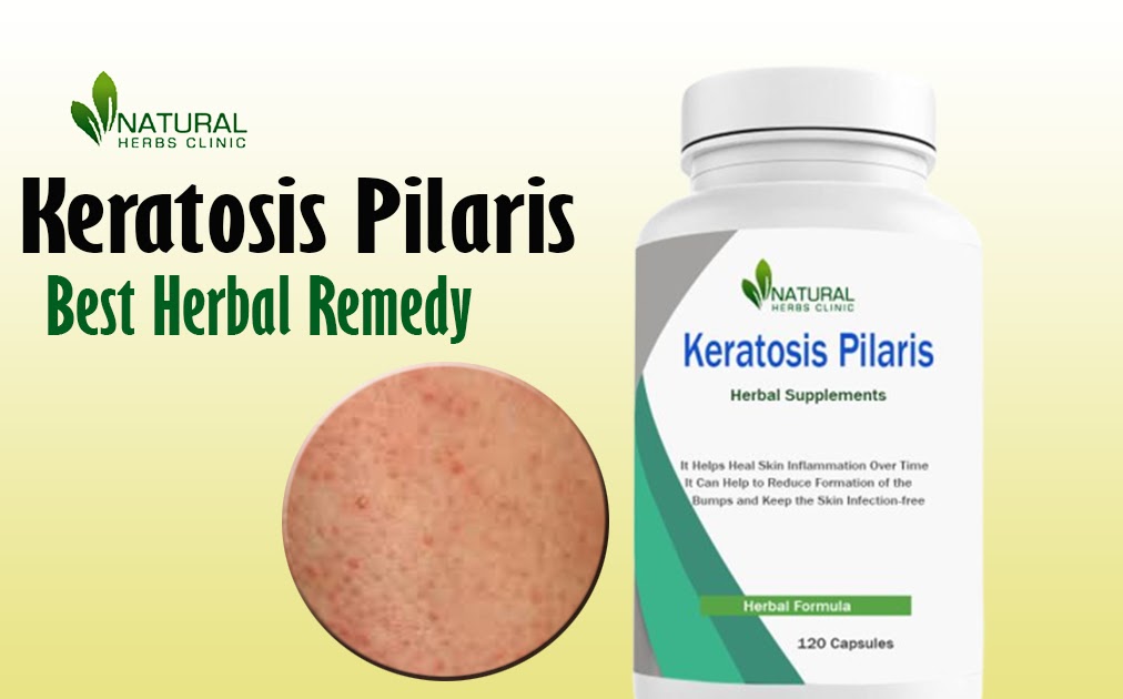 Natural Remedy for Keratosis Pilaris: Cod Liver Oil Treatment