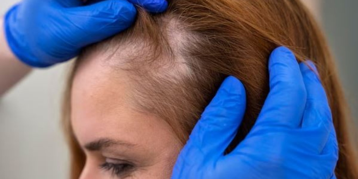 PRP for Hair Loss in Warrenton: A Revolutionary Solution - Lifestyle Physicians