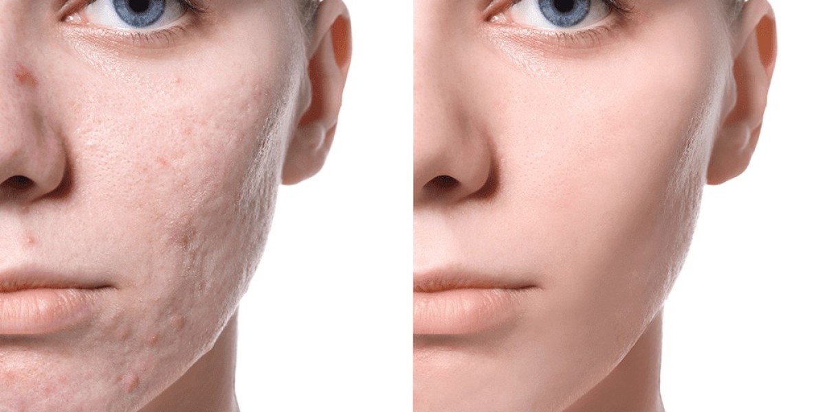 Revitalize Your Skin: Acne Scar Treatments in Dubai