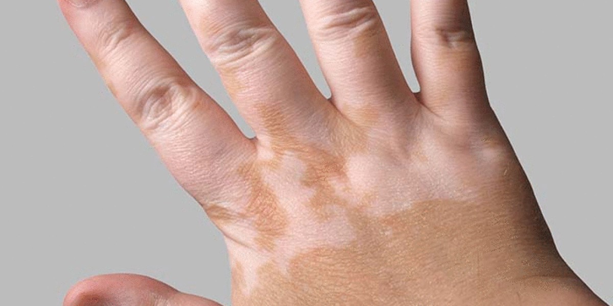 Vitiligo diet – What to eat and avoid