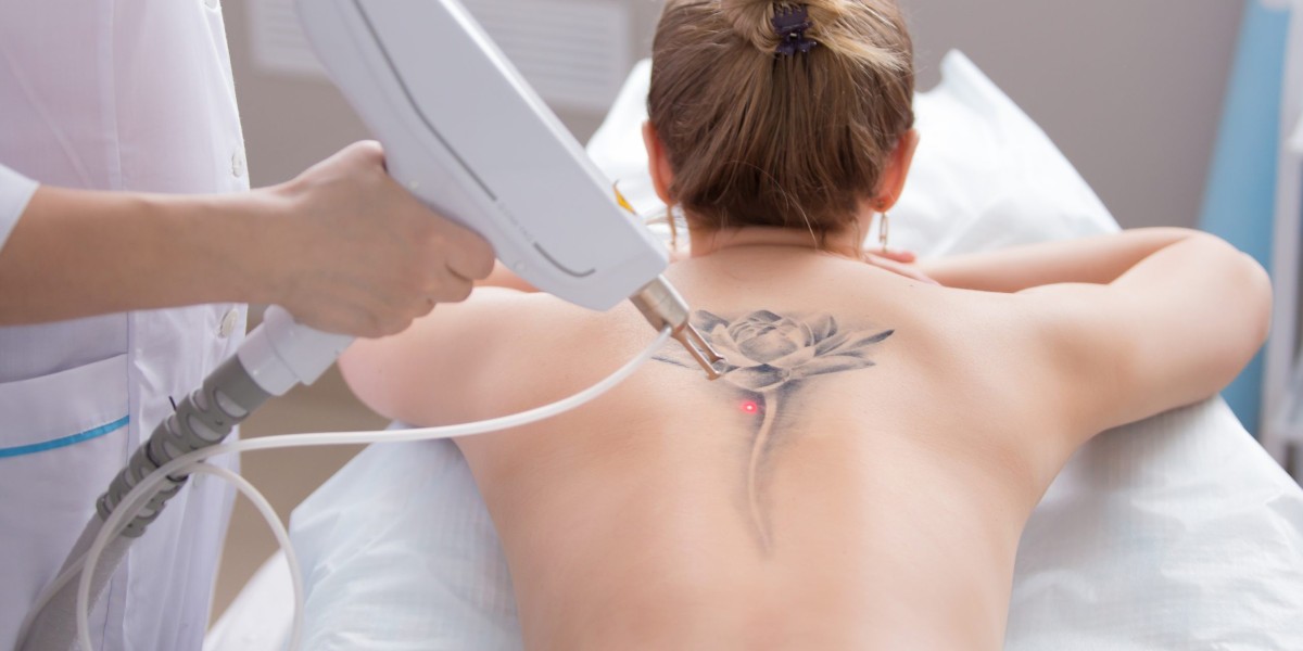 The Ultimate Guide to the Best Laser Tattoo Removal Techniques