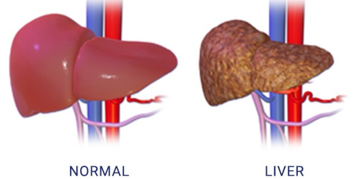 Understanding Liver Cirrhosis: Causes, Symptoms, and Treatment