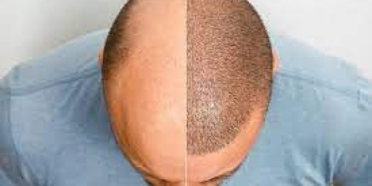  Hair Transplants: Your Path to a More Confident You