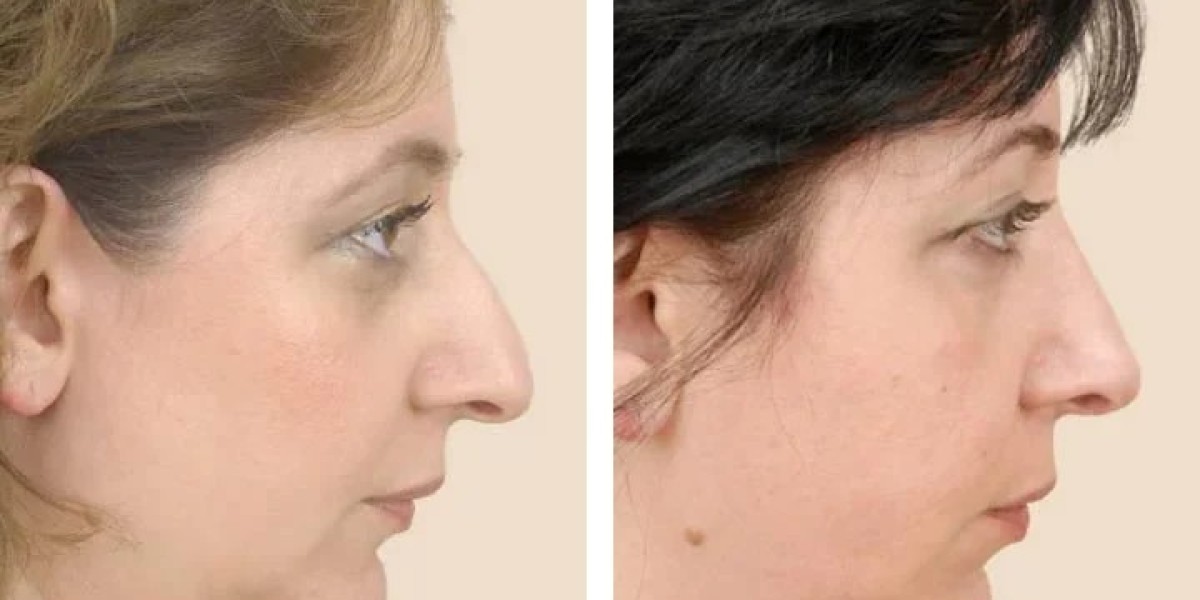 "Age Considerations for Rhinoplasty in Dubai: Is There an Ideal Age?"