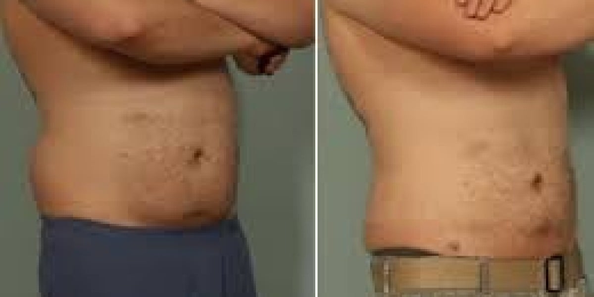 Liposuction Costs: Factors Affecting the Price of Treatment