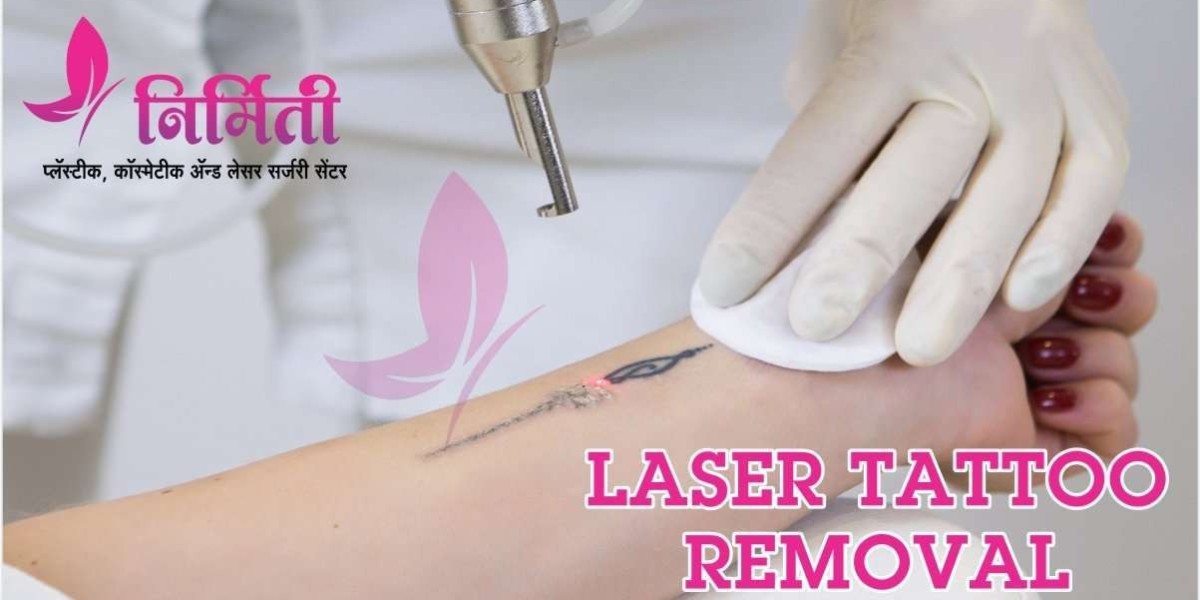 Undo Tattoo Mishaps Effortlessly: Transform with Sangli's Premier Laser Removal Experts!