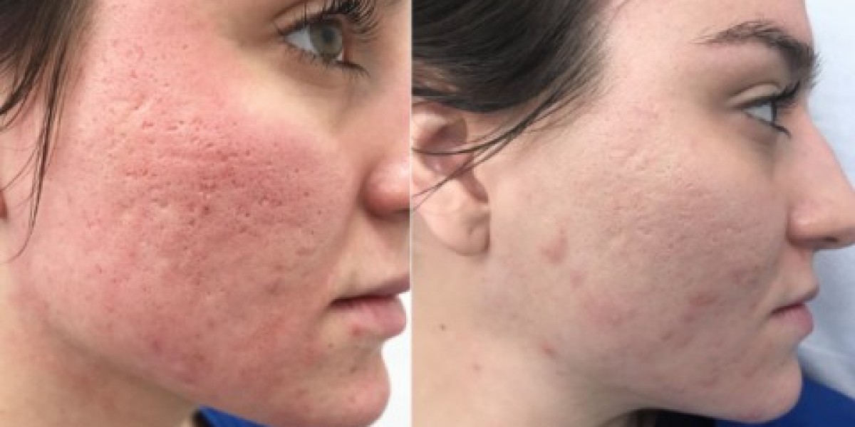 Chemical Peels for Acne Scar Pigmentation: A Brightening Boost
