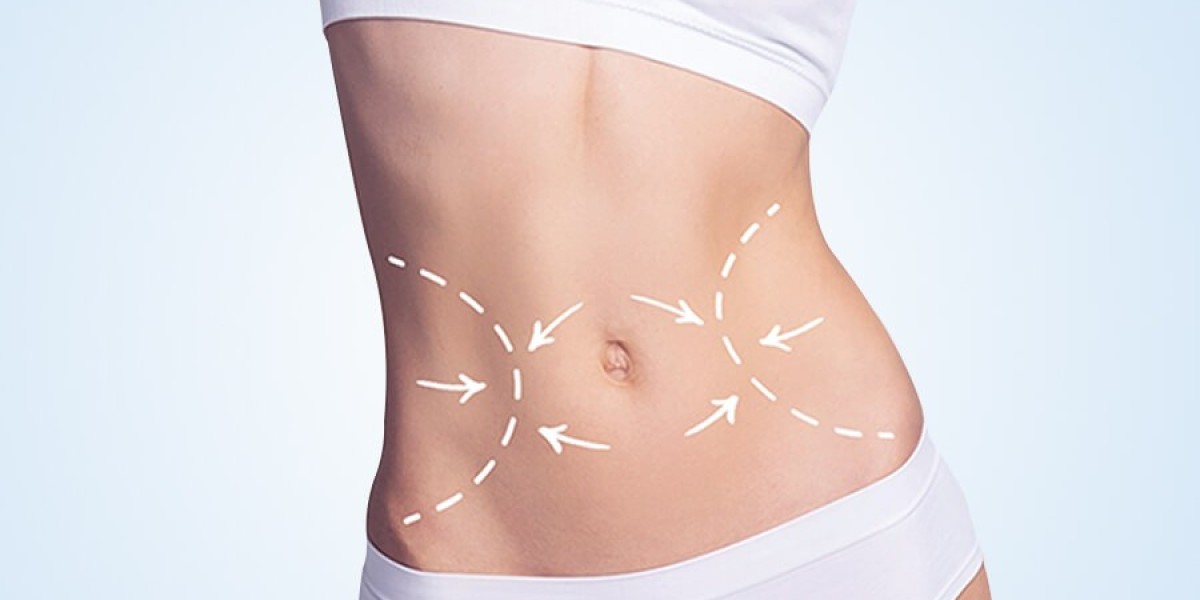Tummy Tuck Recovery: What to Expect After Your Procedure
