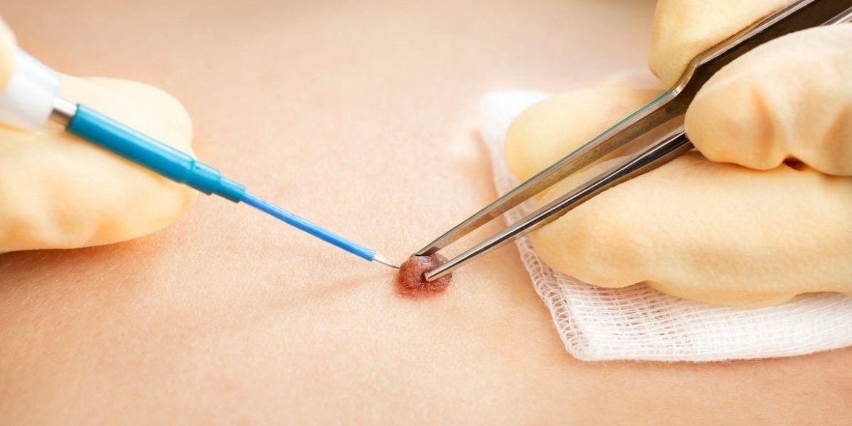 At-Home Mole Removal Kits: Are They Safe or Risky?