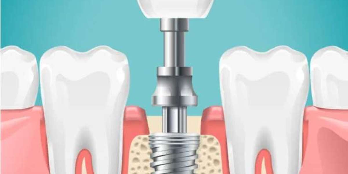 Implant Teeth: The Gateway to a Perfect Smile at Orion Dental Care