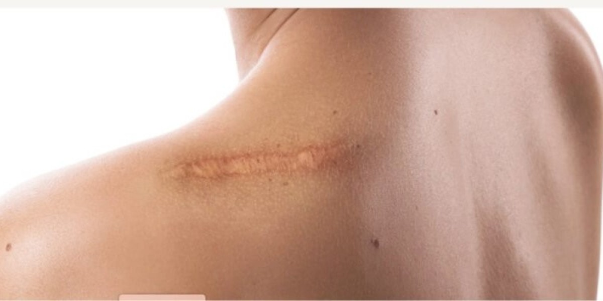 Scarring After Major Surgery: What to Expect and How to Help