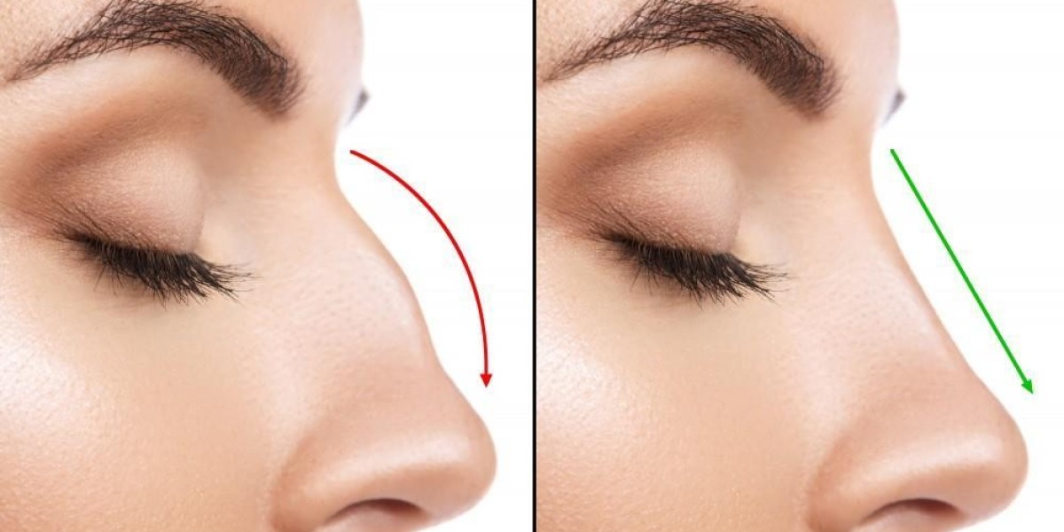 Nasal Reshaping: Exploring the Latest Trends in Rhinoplasty