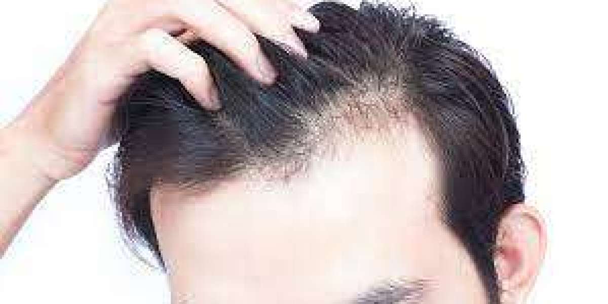 Frontal Hair Loss Due to Alopecia Areata: Understanding the Condition