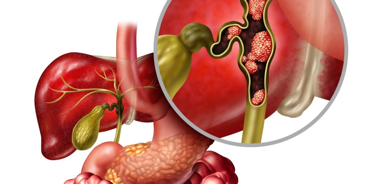 Global Bile Duct Cancer Market Size, Share, Trend and and Forecast 2021–2030