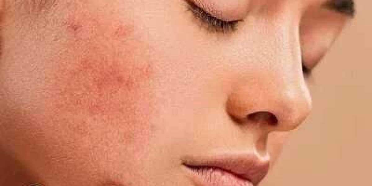Microneedling for Acne Scars: What to Expect