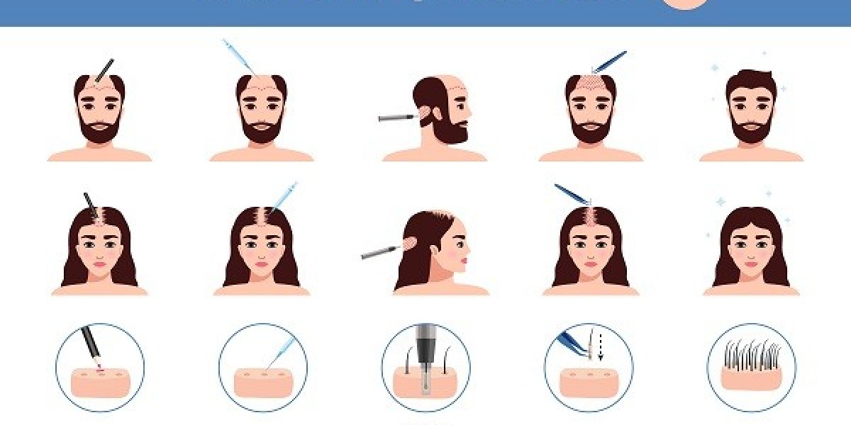 Hair Transplant Market Assessment, Key Factors and Challenges by 2032
