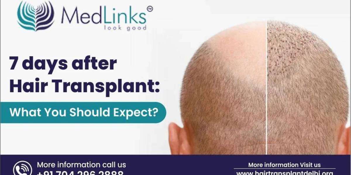 7 Days After Hair Transplant: What You Should Expect?
