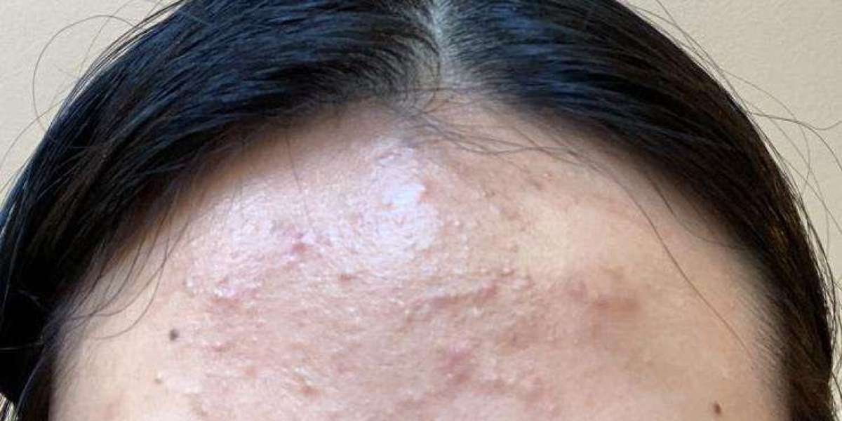 Dubai's Pimple Treatments: A Clear View