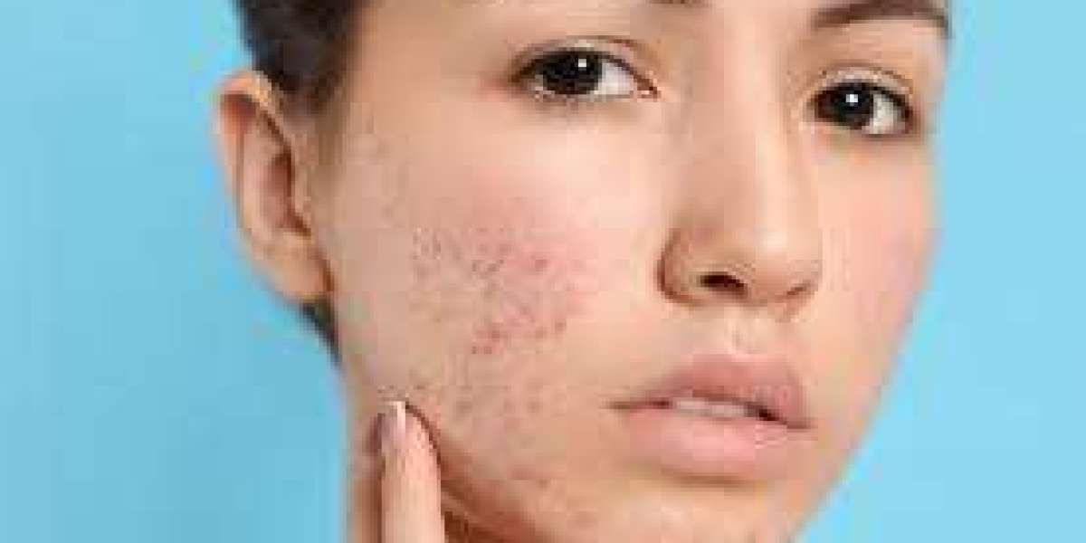 "Dubai's Beauty Oasis: Finding the Right Acne Scar Treatment for You"