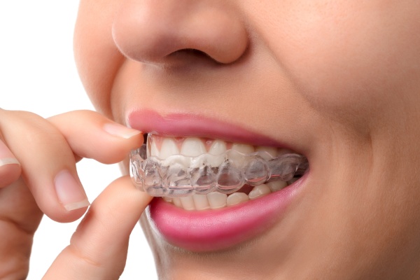 Invisible braces, visible results: Learn about clear aligners treatment