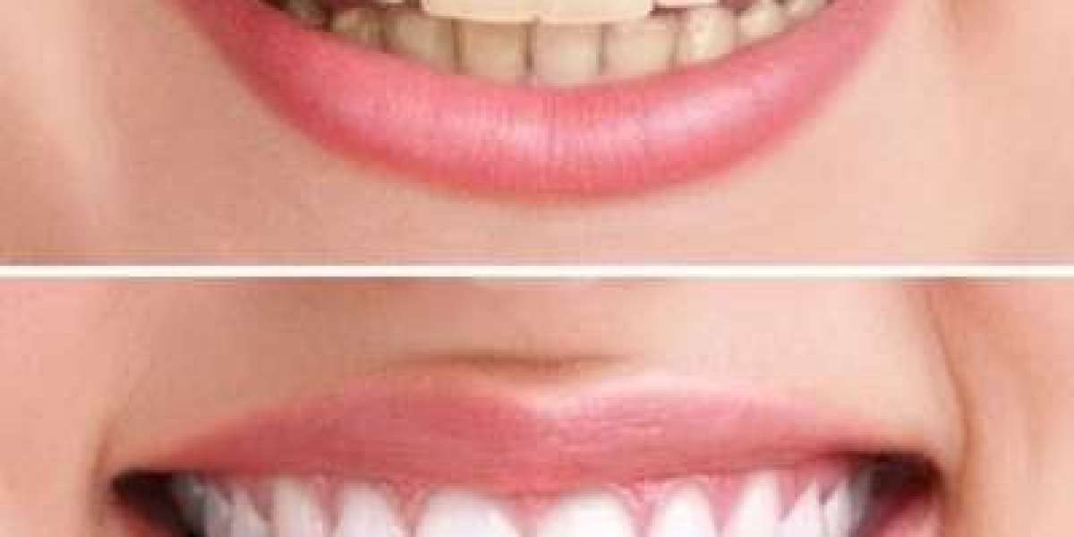 Laser Teeth Whitening: What to Expect