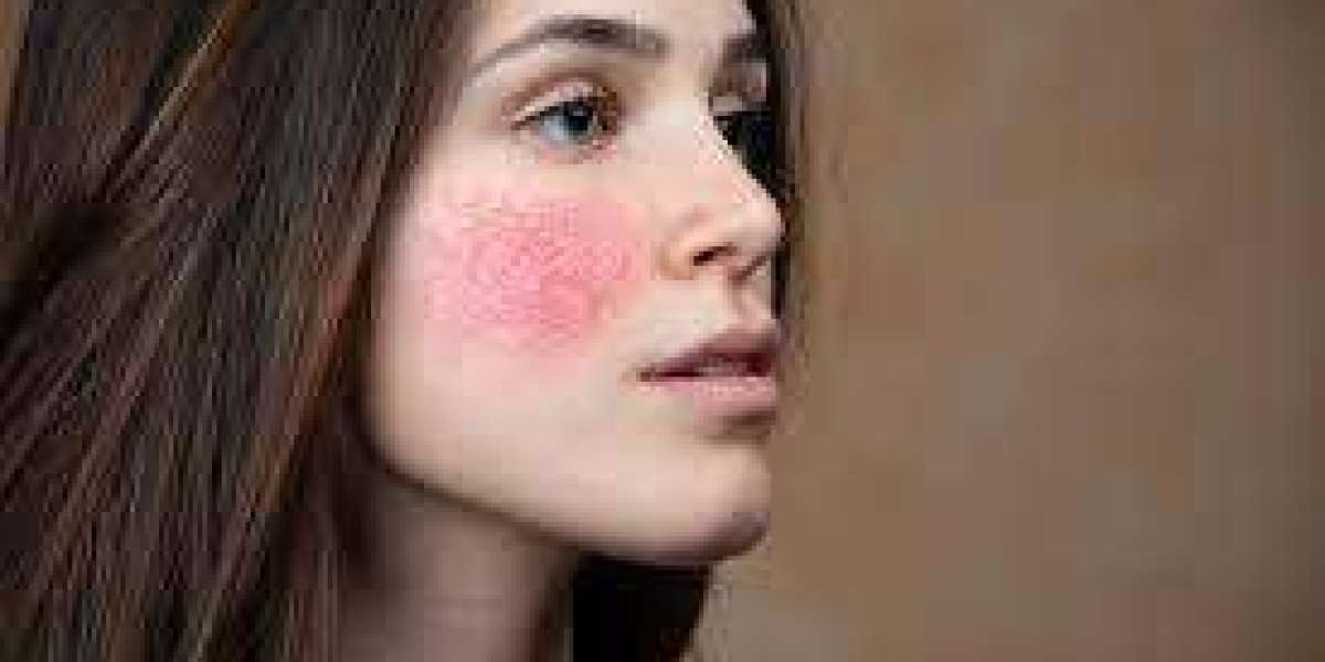 "Dubai's Dermatology Delight: Uncovering the Best Rosacea Treatments"