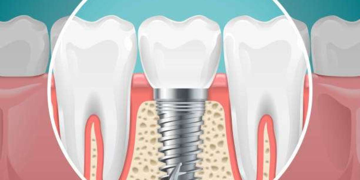 A New Smile Awaits: Dental Implants in Abu Dhabi