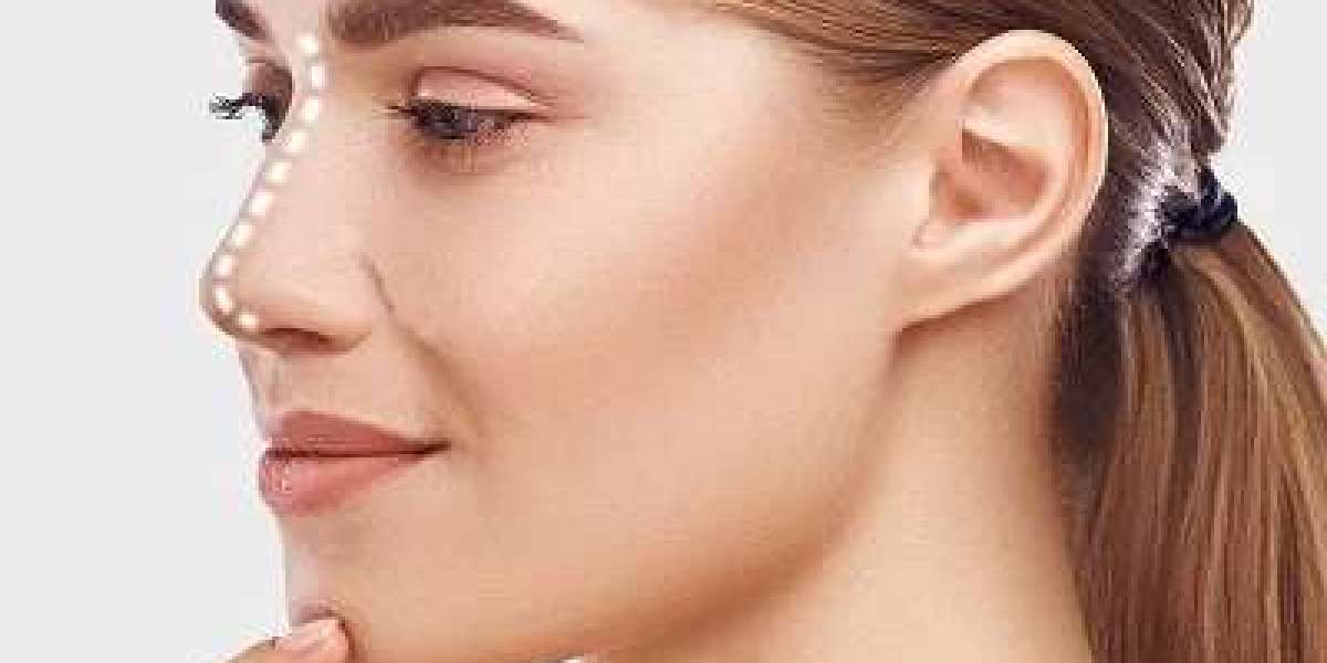 Threaded Elegance: Hiko Nose Lift for a Graceful Profile