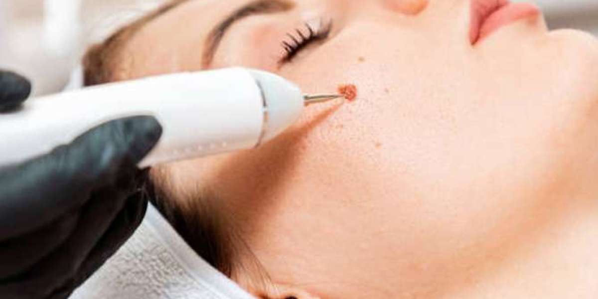 Flawless Skin Awaits: Exploring Laser Birthmark Treatments