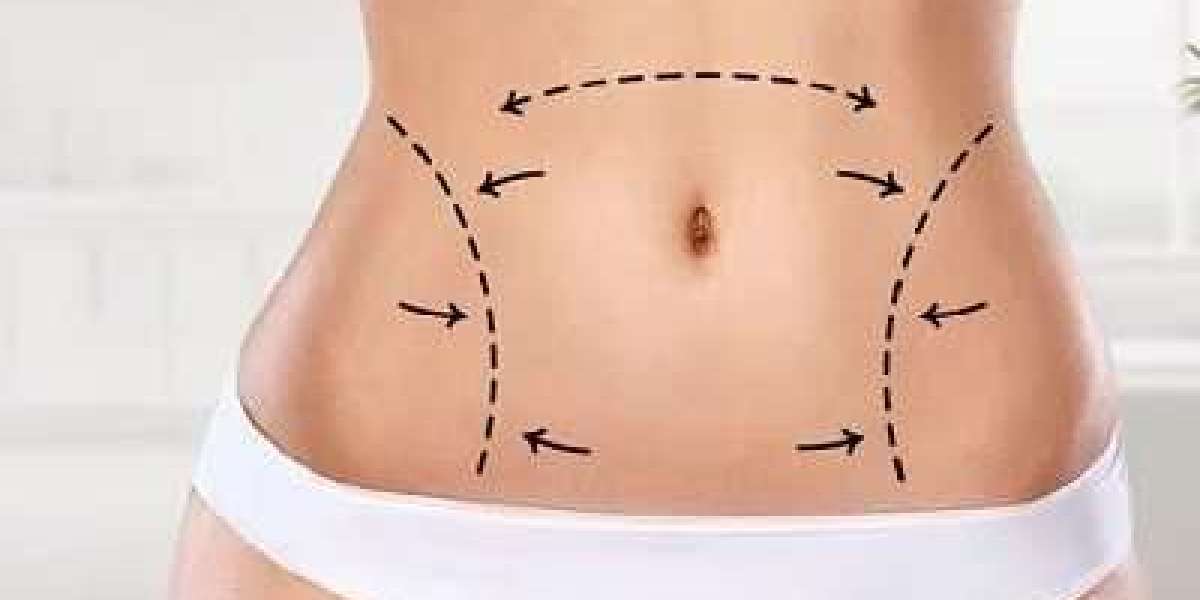 Liposuction for Bodybuilders: Sculpting the Ideal Physique