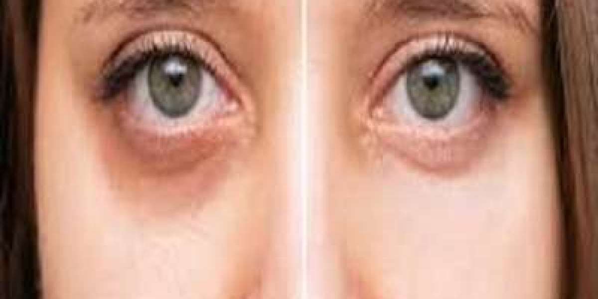 Brighten Up: Your Guide to Dark Circles Treatment Options in Dubai
