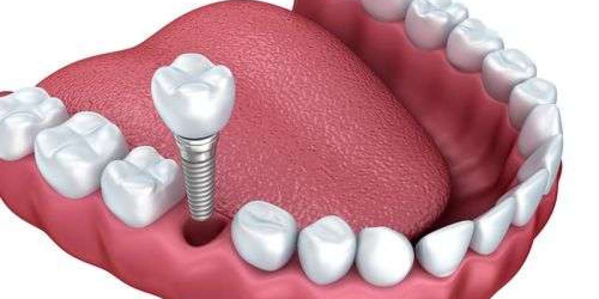 Revive Your Smile: Dental Implants for Lasting Confidence