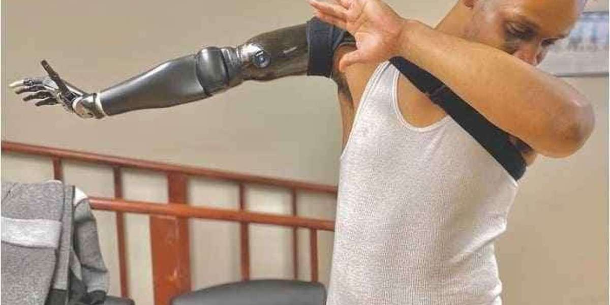 Advancements in Prosthetic Arms: Exploring Functional Prosthetic Shoulder Clinics in India