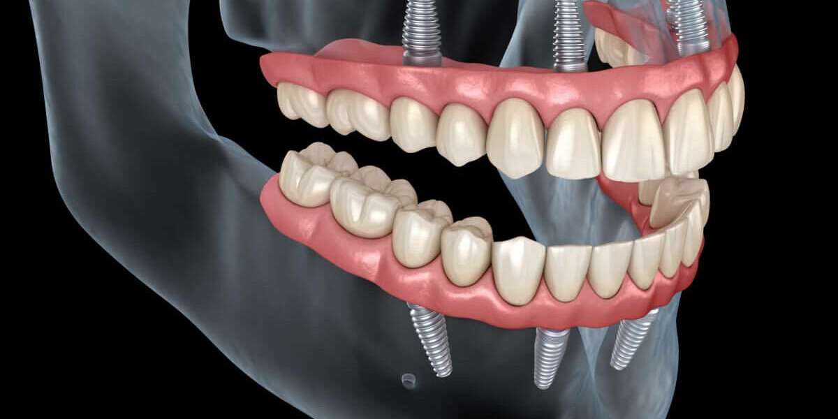 Affordable All-on-4 Dental Implants: Full-Arch Restoration on a Budget