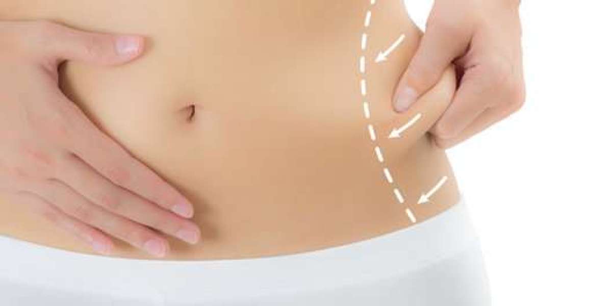 The Comprehensive Benefits of Liposuction