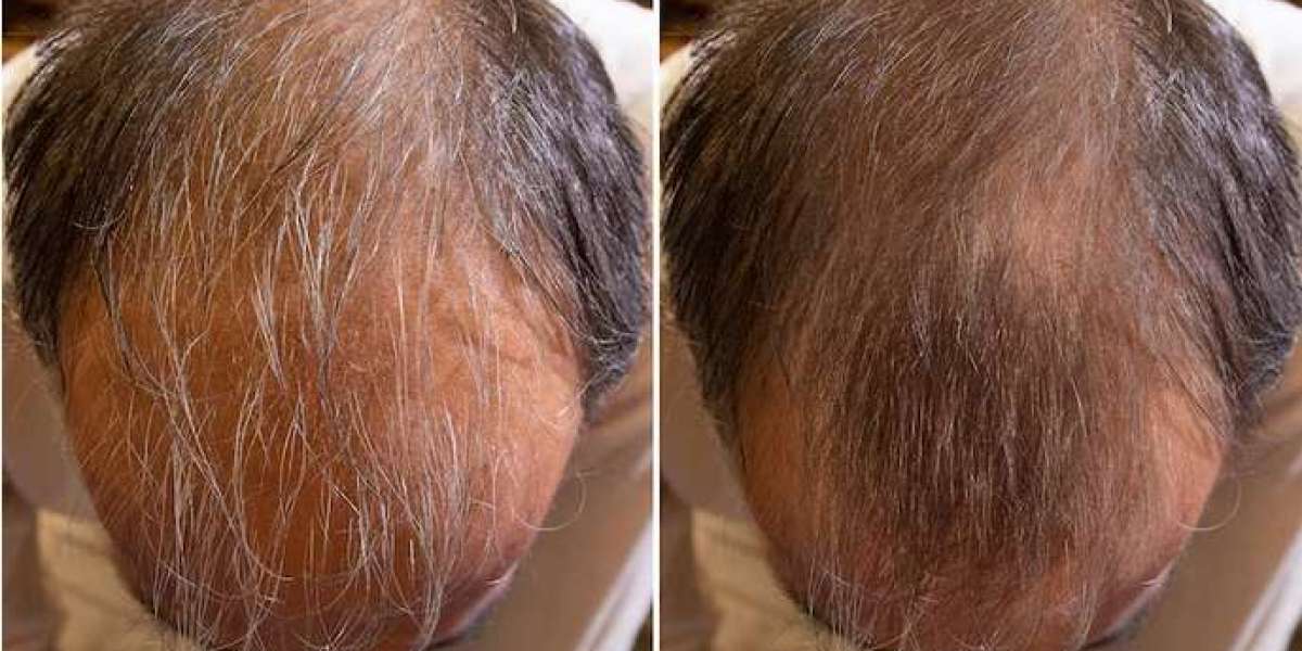 Transformative Tresses: Witness the Before and After of Hair Transplants in Turkey