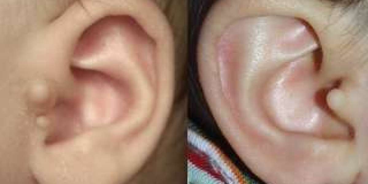 Patient Experiences: Life After Preauricular Tag Removal