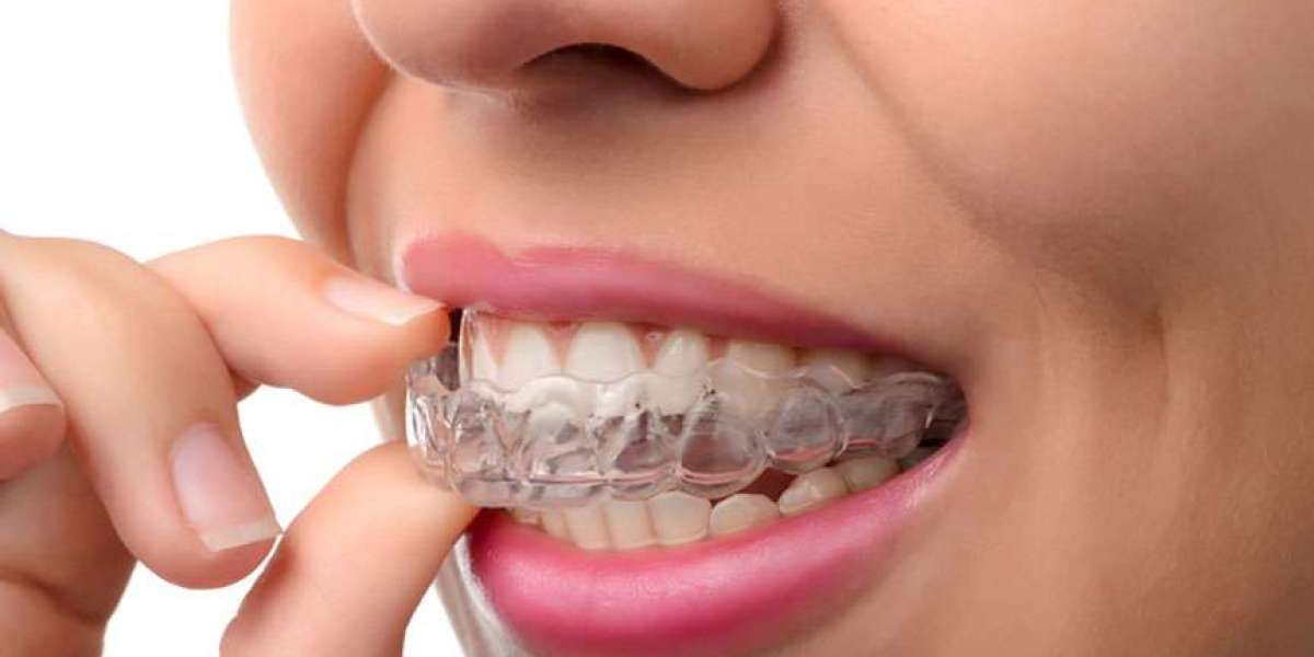Smile in Style: The Ultimate Guide to Invisalign Braces