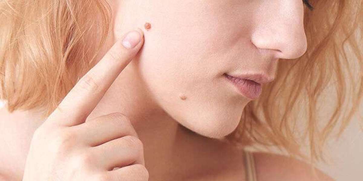 Top 10 Skin Tags Removal Tips: Your Ultimate Guide