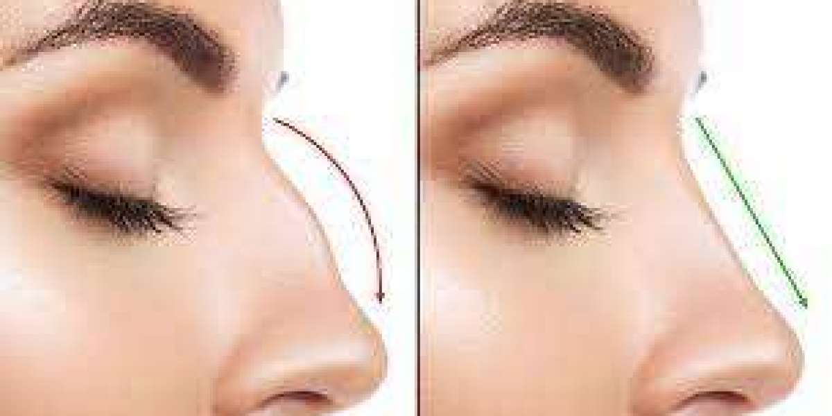 Dubai's Rhinoplasty Trends: Crafting the Ideal Nose, One Tip at a Time!