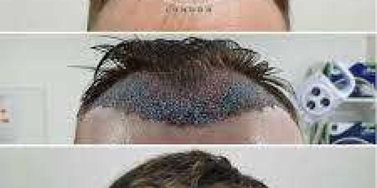 scalp micropigmentation cost in India