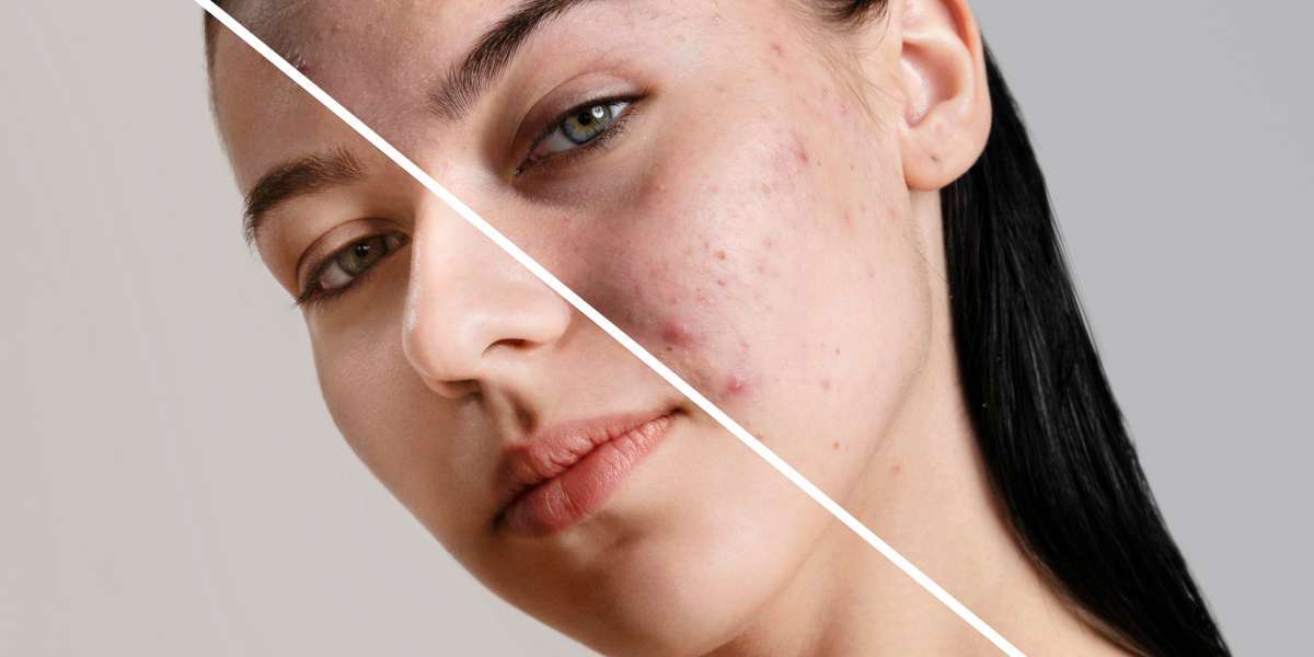 Holistic Approaches to Acne Treatment: Mind, Body, and Skin