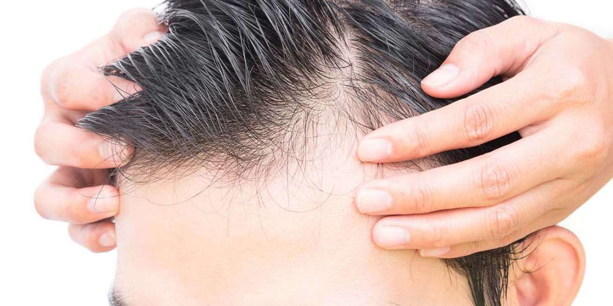 The Mane Event: Progress in Alopecia Areata Restoration Techniques