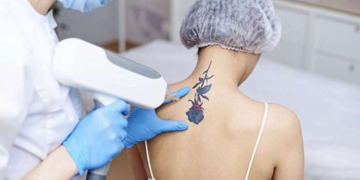 Tattoo Removal Success: Achieving Satisfactory Results